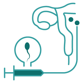 การฉีดอสุจิเข้าสู่โพรงมดลูก (IUI : Intrauterine Insemination)